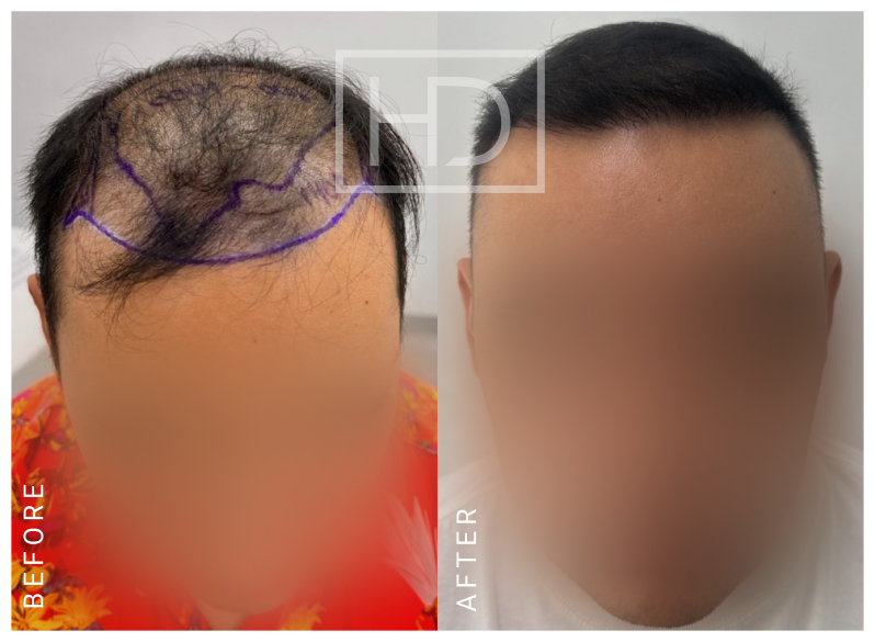 Nurse Hair Transplant
