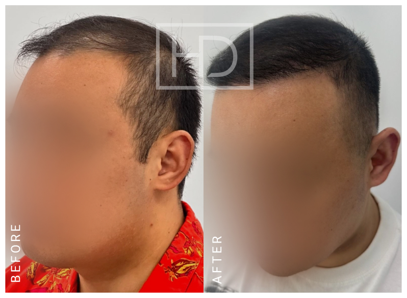 Nurse Hair Transplant