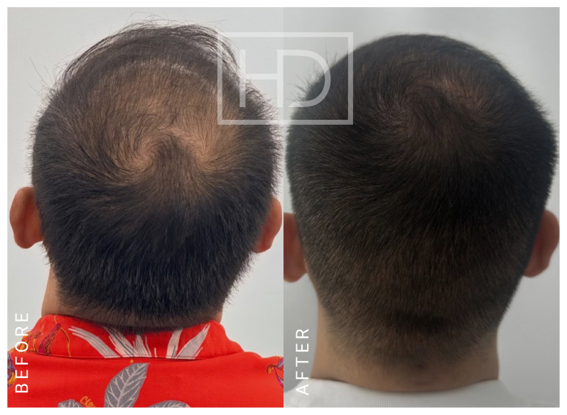 Nurse Hair Transplant