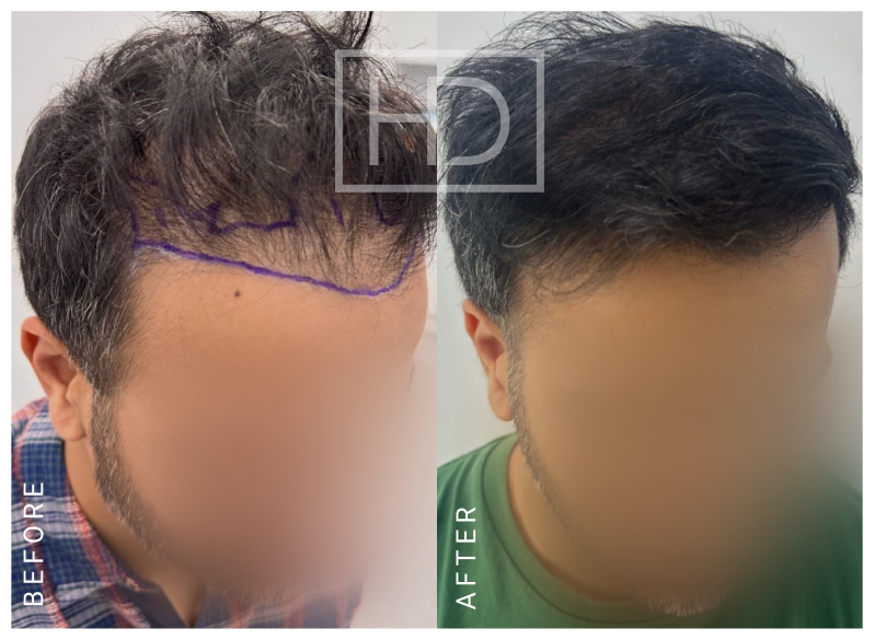 Nurse Hair Transplant