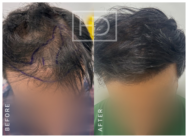 Nurse Hair Transplant