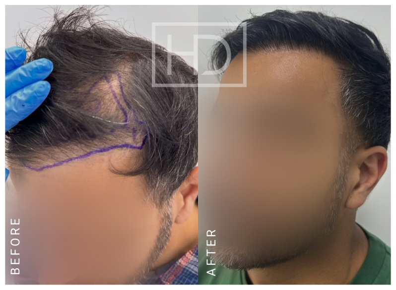 Nurse Hair Transplant