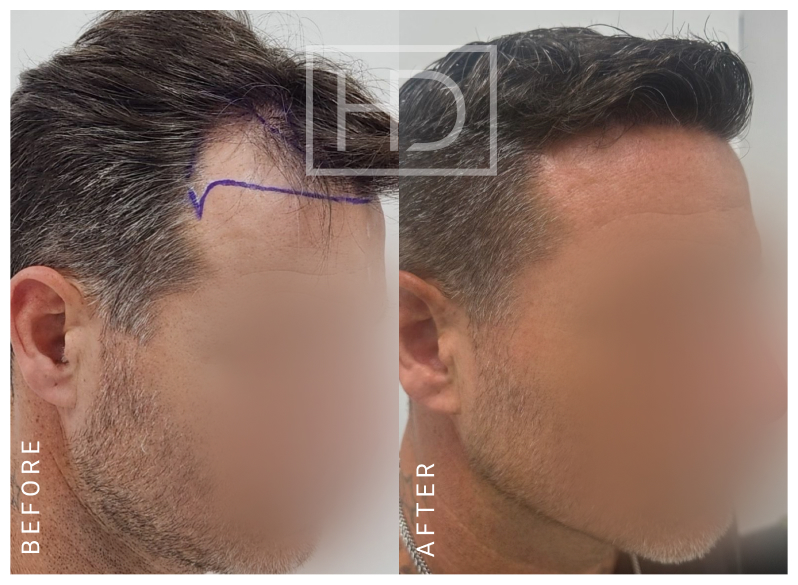 Nurse Hair Transplant