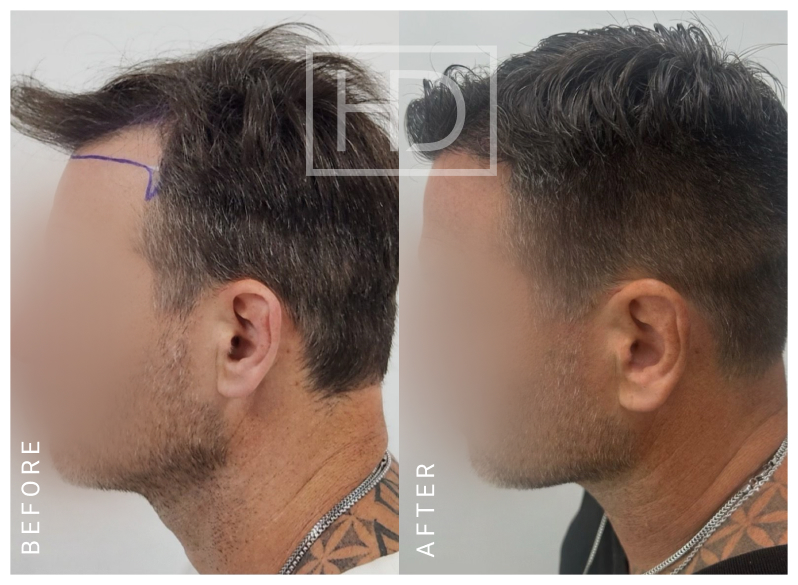 Nurse Hair Transplant