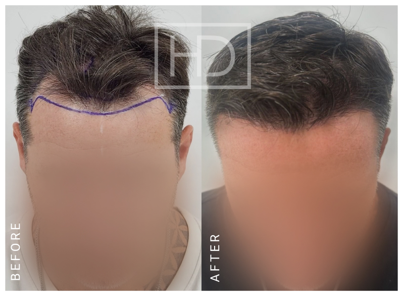Nurse Hair Transplant