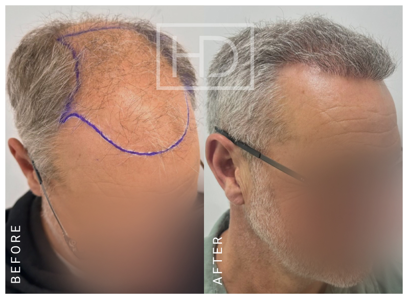 Nurse Hair Transplant