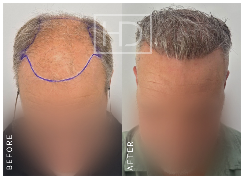 Nurse Hair Transplant