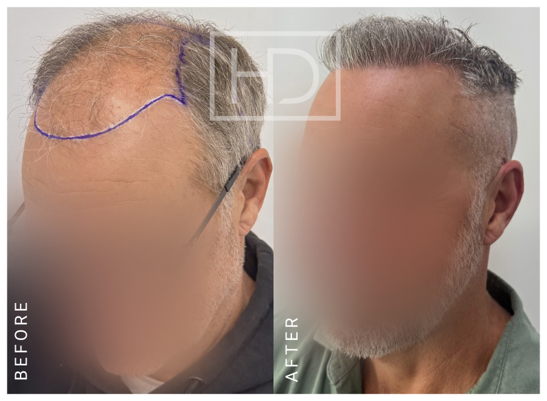 Nurse Hair Transplant