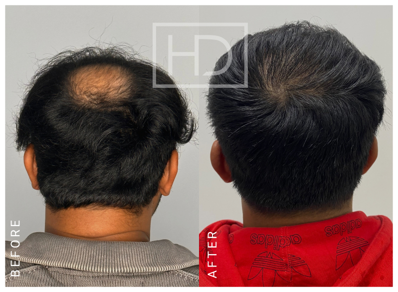 Nurse Hair Transplant