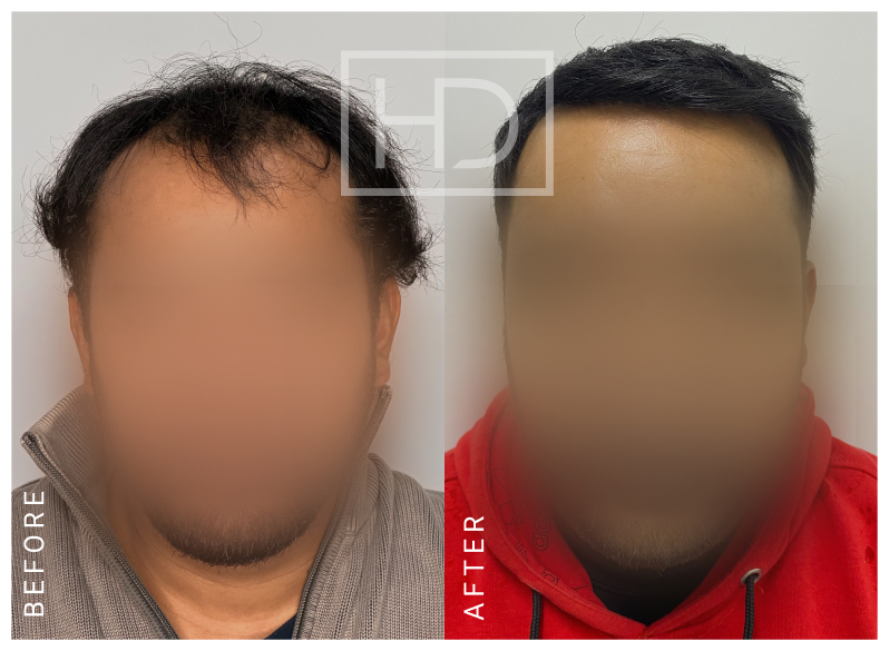 Nurse Hair Transplant