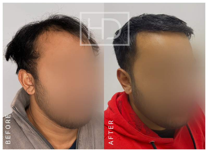 Nurse Hair Transplant