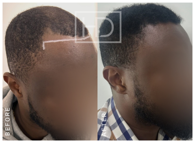 Nurse Hair Transplant
