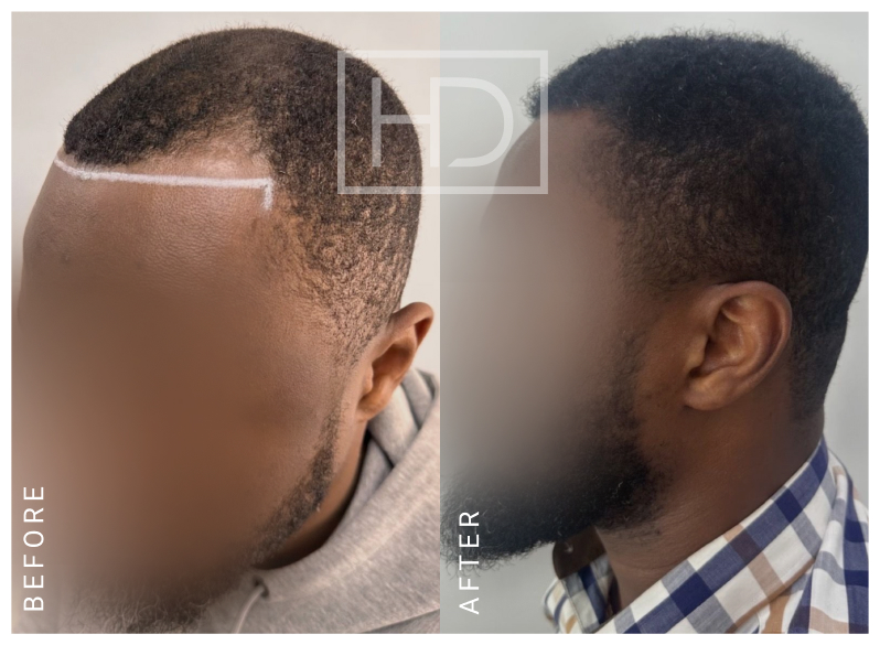 Nurse Hair Transplant