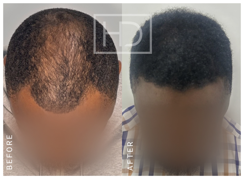 Nurse Hair Transplant