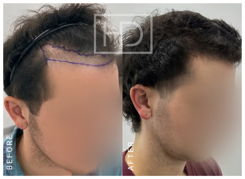 Nurse Hair Transplant