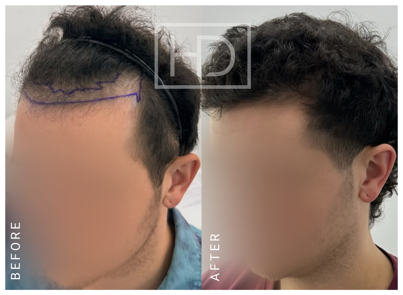 Nurse Hair Transplant