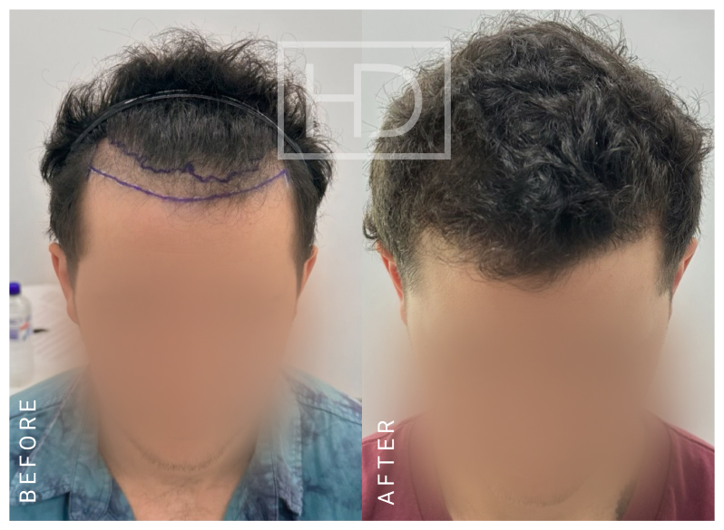 Nurse Hair Transplant