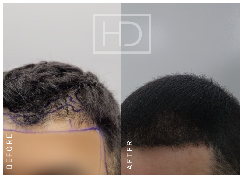 Nurse Hair Transplant