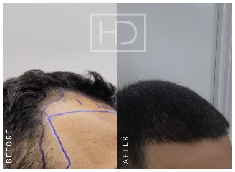 Nurse Hair Transplant