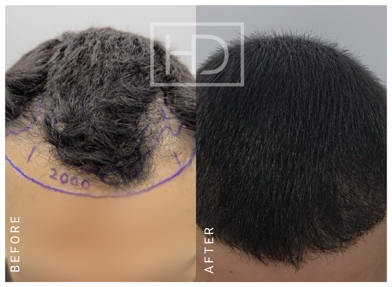 Nurse Hair Transplant