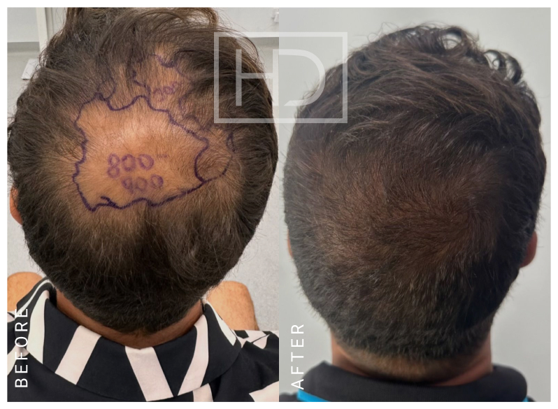Nurse Hair Transplant