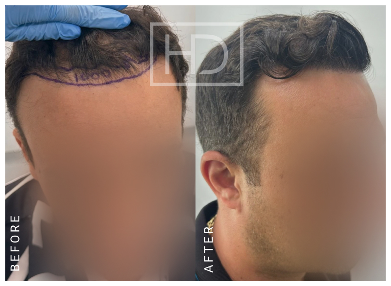 Nurse Hair Transplant