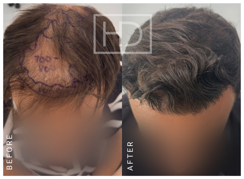 Nurse Hair Transplant