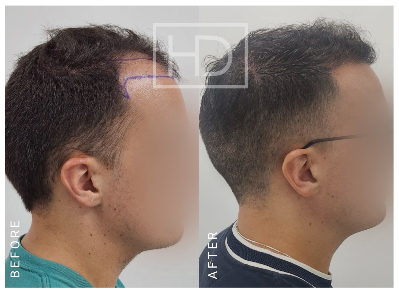 Nurse Hair Transplant