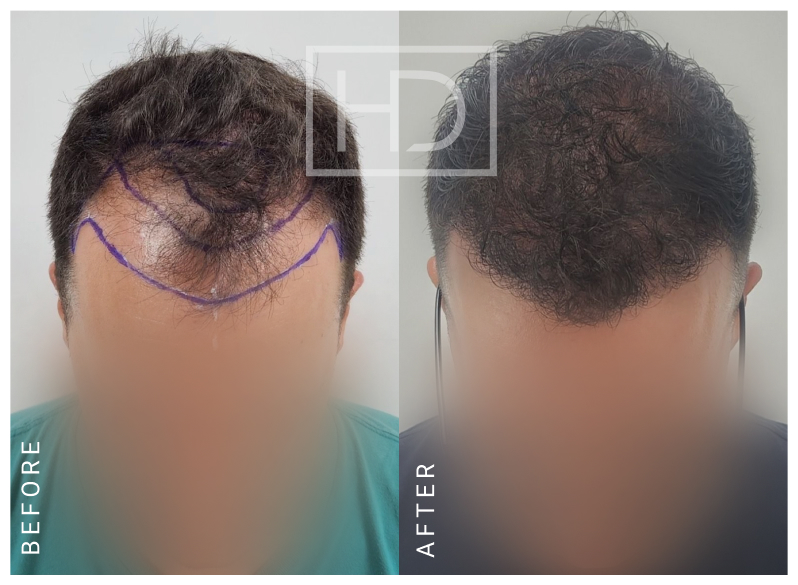 Nurse Hair Transplant