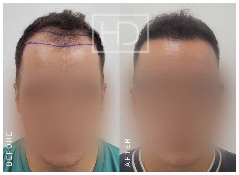 Nurse Hair Transplant