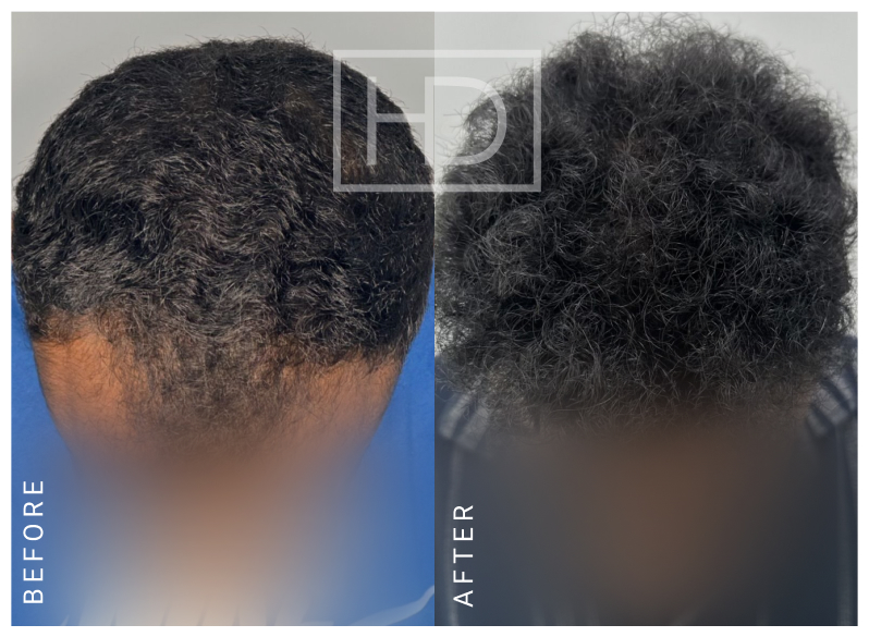 Nurse Hair Transplant