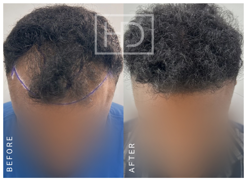Nurse Hair Transplant