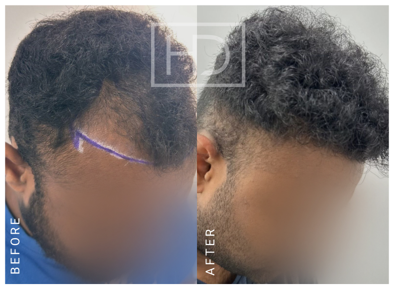 Nurse Hair Transplant