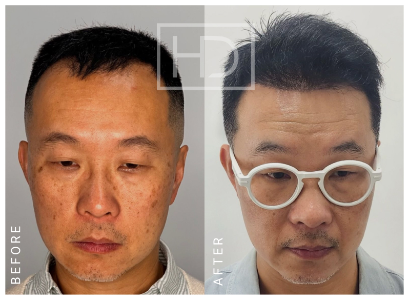 Nurse Hair Transplant Before & After