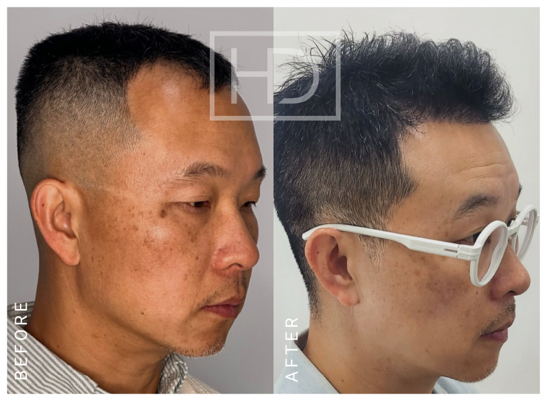 Nurse Hair Transplant Before & After