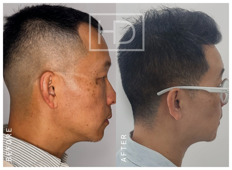 Nurse Hair Transplant Before & After