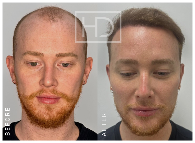 Nurse Hair Transplant Before & After