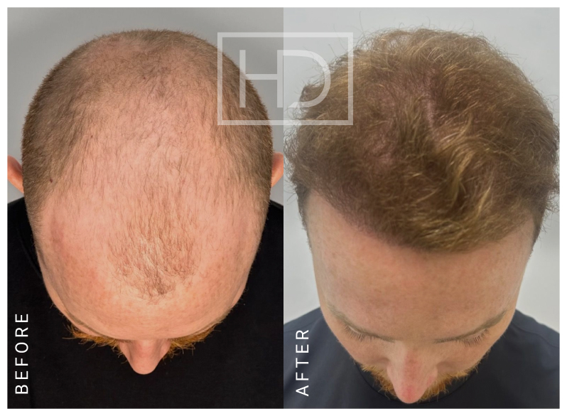 Nurse Hair Transplant Before & After