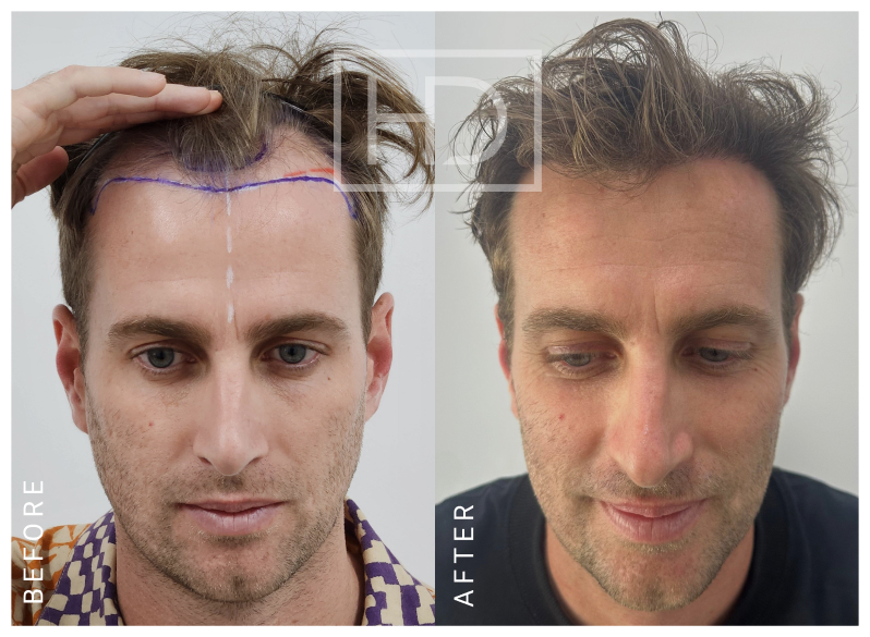 Nurse Hair Transplant Before & After