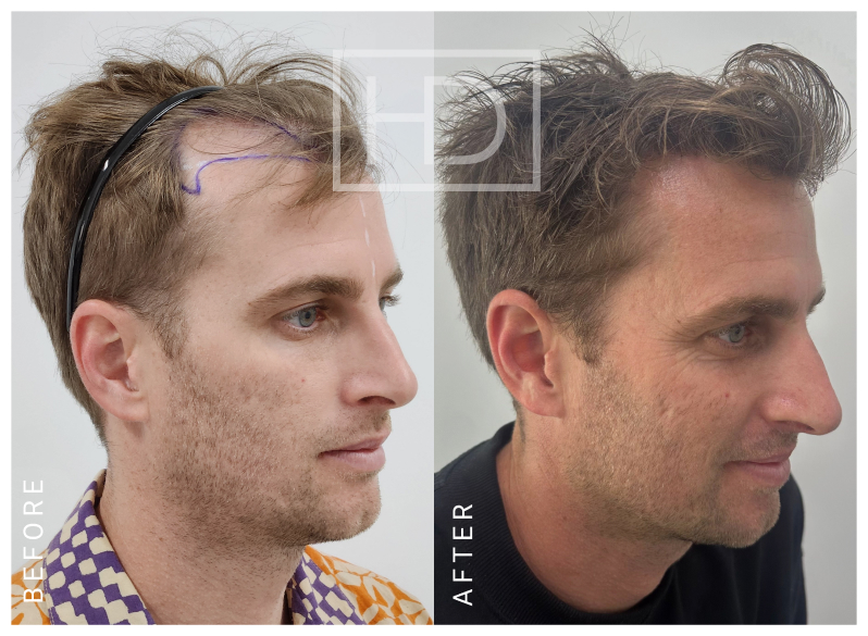 Nurse Hair Transplant Before & After