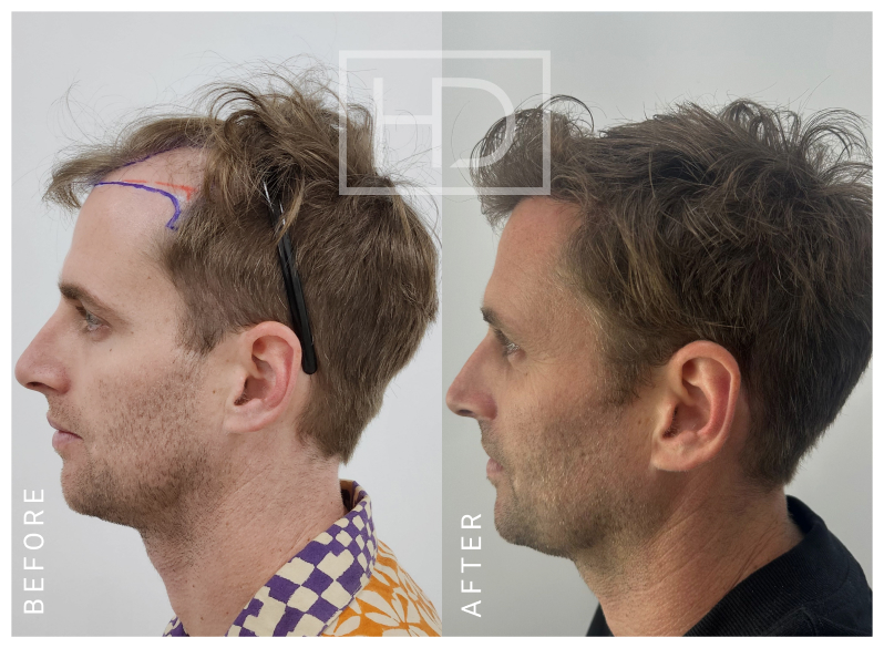 Nurse Hair Transplant Before & After
