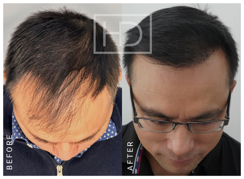 Nurse Hair Transplant