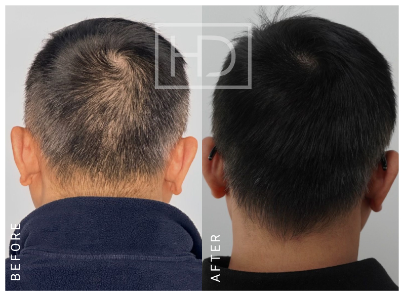 Nurse Hair Transplant Before & After