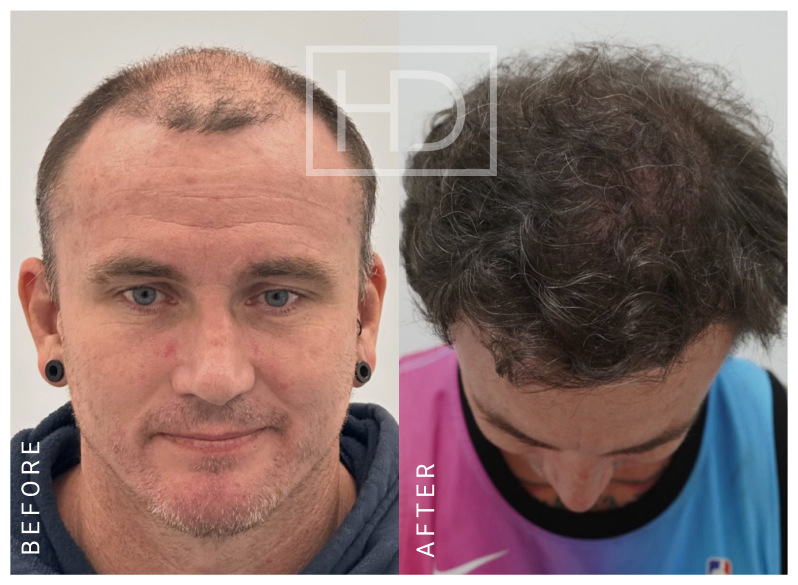 Nurse Hair Transplant Before & After