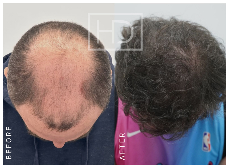 Nurse Hair Transplant Before & After