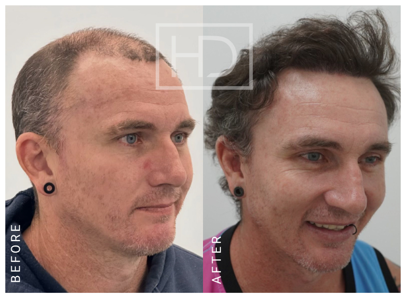 Nurse Hair Transplant Before & After