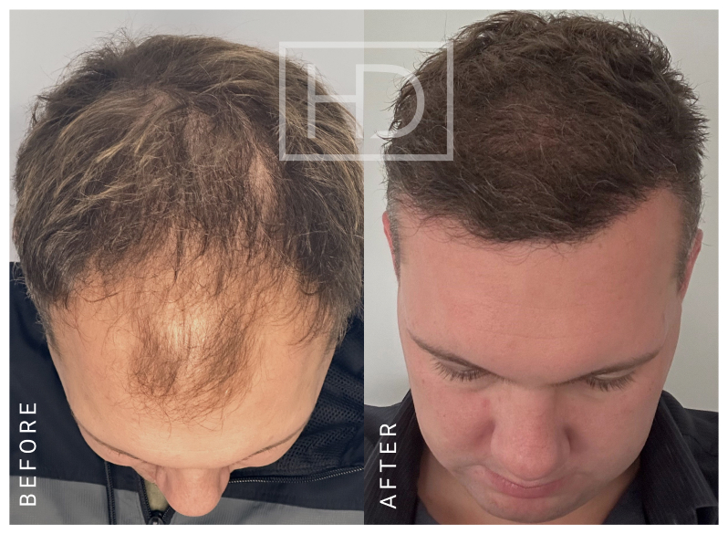 Nurse Hair Transplant Before & After