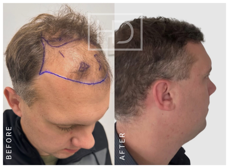 Nurse Hair Transplant Before & After