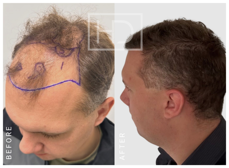Nurse Hair Transplant Before & After