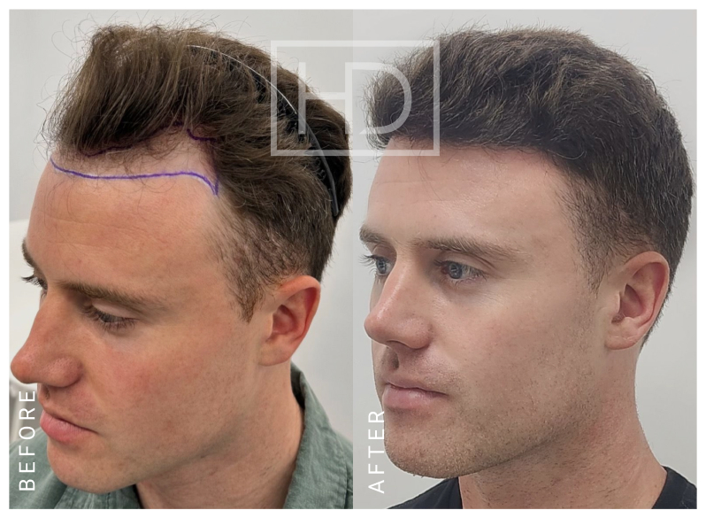 Nurse Hair Transplant Before & After